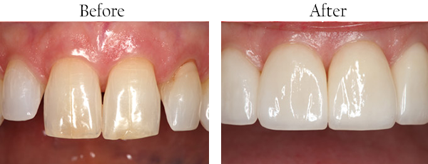 Saugus Smile Makeover